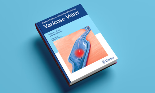 Suy giãn tĩnh mạch – Thieme