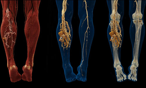Dị dạng thông động tĩnh mạch cẳng chân