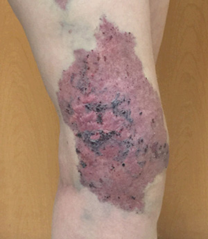 Bớt rượu vang ở vùng đùi của một bệnh nhân KTS