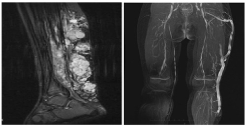 Ảnh cộng hưởng từ bệnh nhân mắc Hội chứng Klippel-Trenaunay