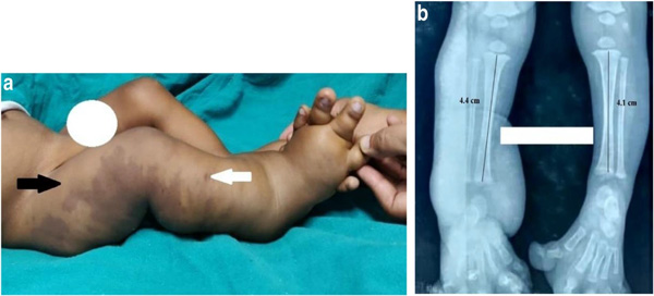 Trẻ em mắc hội chứng Klippel-Trenaunay