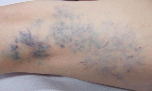 Nghiên cứu đặc điểm lâm sàng, cận lâm sàng và xây dựng phác đồ điều trị dị dạng tĩnh mạch