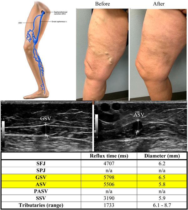 điều trị tĩnh mạch hiển trước đồng thời với tĩnh mạch hiển lớn