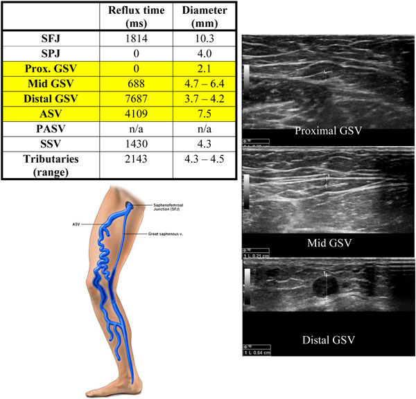 điều trị trào ngược trong ASV