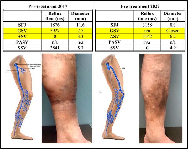 ASV tái phát sau điều tị GSV