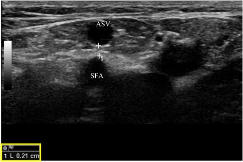 Khoảng cách từ động mạch đùi nông tới tĩnh mạch hiển trước