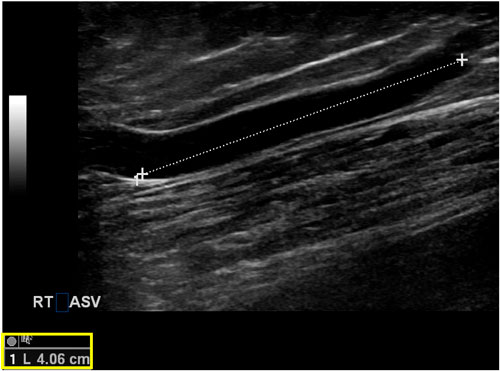 tĩnh mạch hiển trước đoạn trong khoang hiển