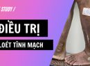 Kết quả điều trị bệnh nhân loét tĩnh mạch, ghi nhận sau 1 năm