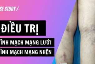 Ca bệnh giãn tĩnh mạch mạng lưới và tĩnh mạch mạng nhện mức độ nhiều