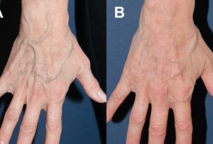 Liệu pháp tiêm xơ điều trị tĩnh mạch mạng lưới ở mu bàn tay: một đánh giá hồi cứu