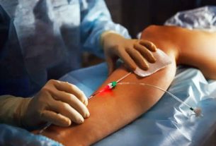 Nghiên cứu mới về hiệu quả của chế độ laser xung trong can thiệp nội mạch