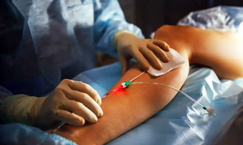 Nghiên cứu mới về hiệu quả của chế độ laser xung trong can thiệp nội mạch