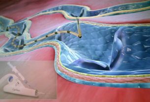 Nghiên cứu về hiệu quả dài hạn của thiết bị Clarivein trong điều trị suy tĩnh mạch hiển